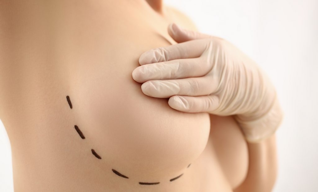 Borstvergroting Plastische chirurgie