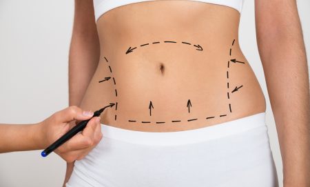 Buikwandcorrectie - abdominoplastie